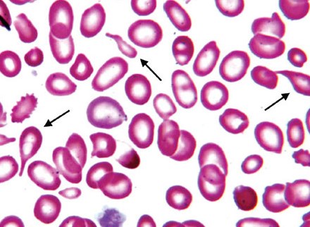 метаболическая анемия - картина крови